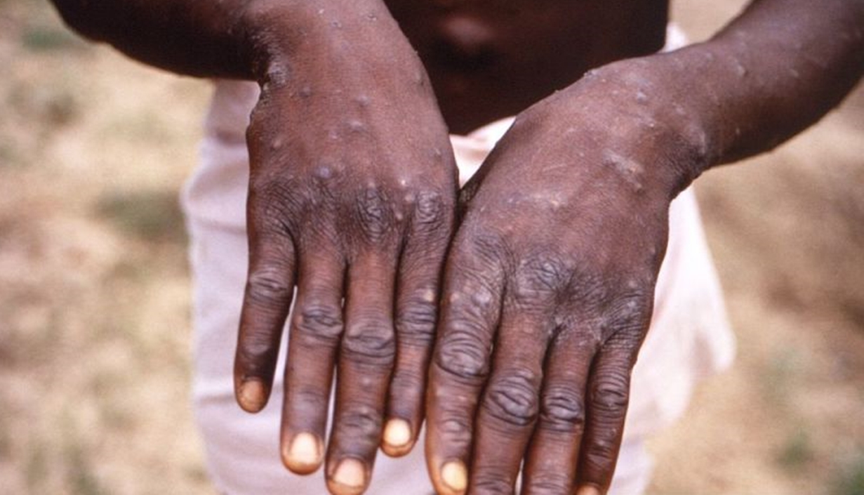Puluhan kasus cacar monyet bermunculan di Nigeria Puluhan kasus cacar monyet bermunculan di Nigeria
