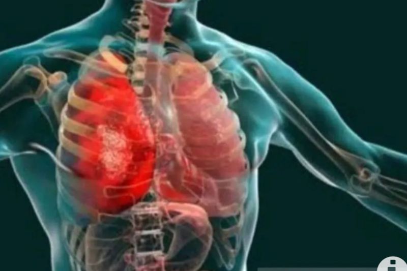 Dinkes DKI sosialisasikan tiga cara cegah mycoplasma pneumonia Dinkes DKI sosialisasikan tiga cara cegah mycoplasma pneumonia