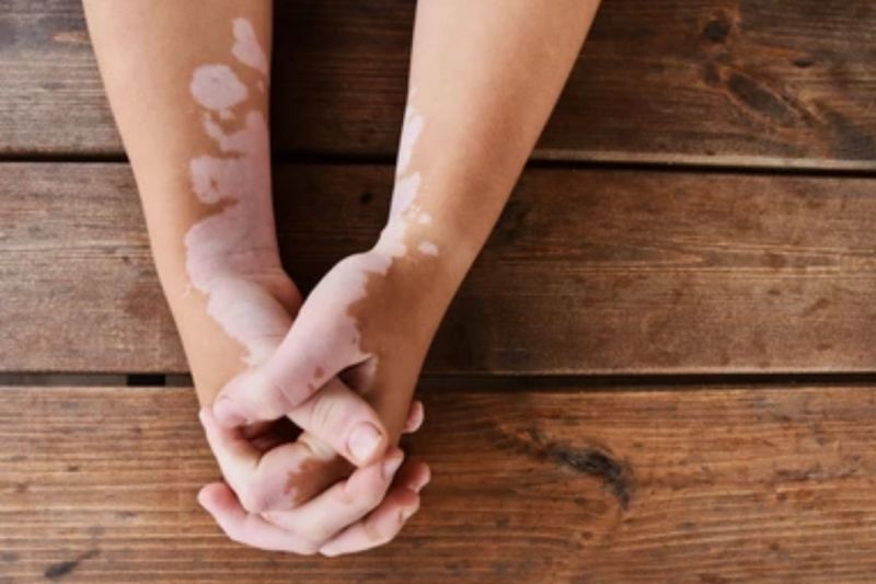 Stres berkontribusi pada kekambuhan Multipel Sklerosis Stres berkontribusi pada kekambuhan Multipel Sklerosis