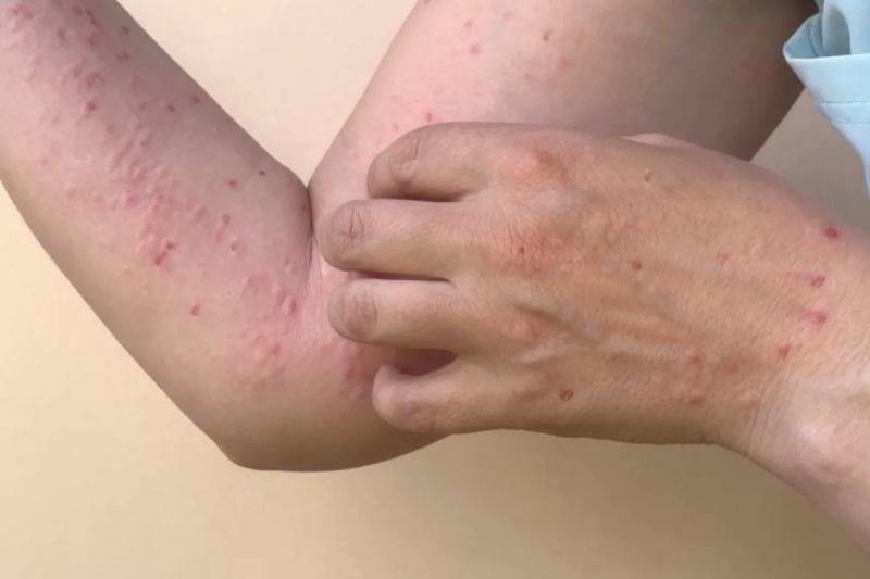 Kemenkes deteksi kasus Mpox di lima provinsi Kemenkes deteksi kasus Mpox di lima provinsi