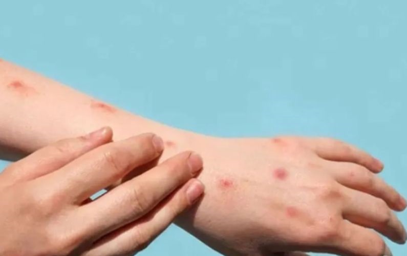 Penyakit cacar monyet menginjang angka 29 kasus