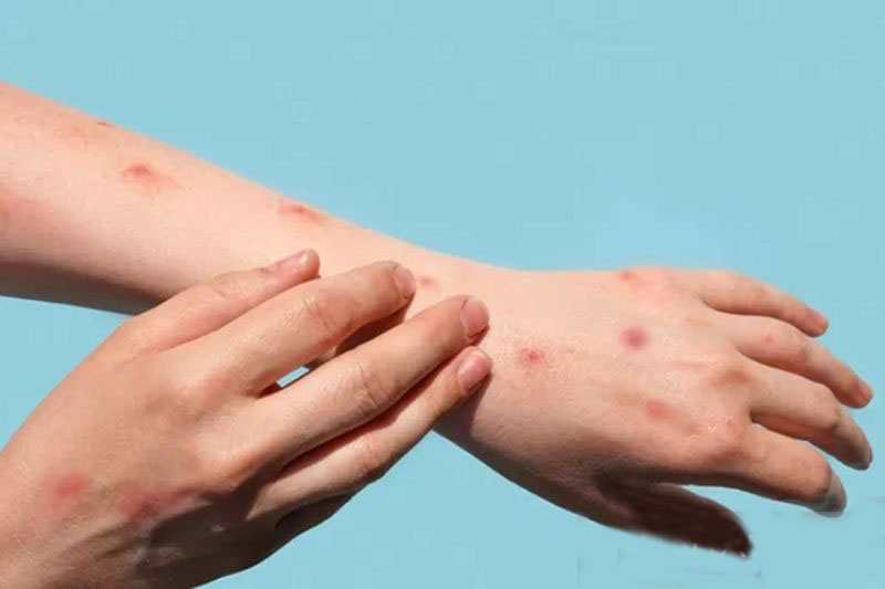 Dinkes temukan tujuh kasus cacar monyet di Jakarta Selatan Dinkes temukan tujuh kasus cacar monyet di Jakarta Selatan