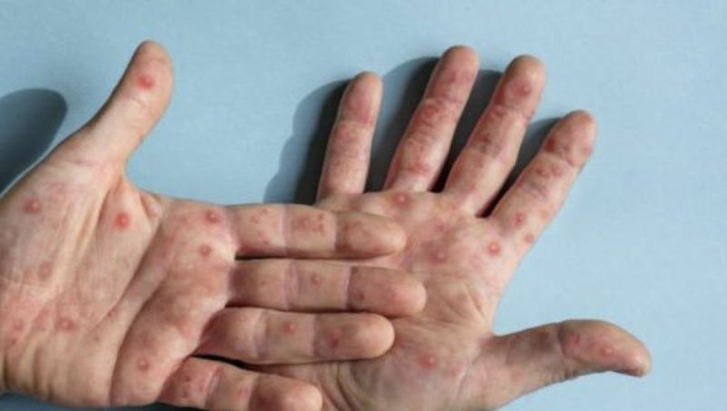 RI waspadai cacar monyet (MPox), ini gejalanya RI waspadai cacar monyet (MPox), ini gejalanya
