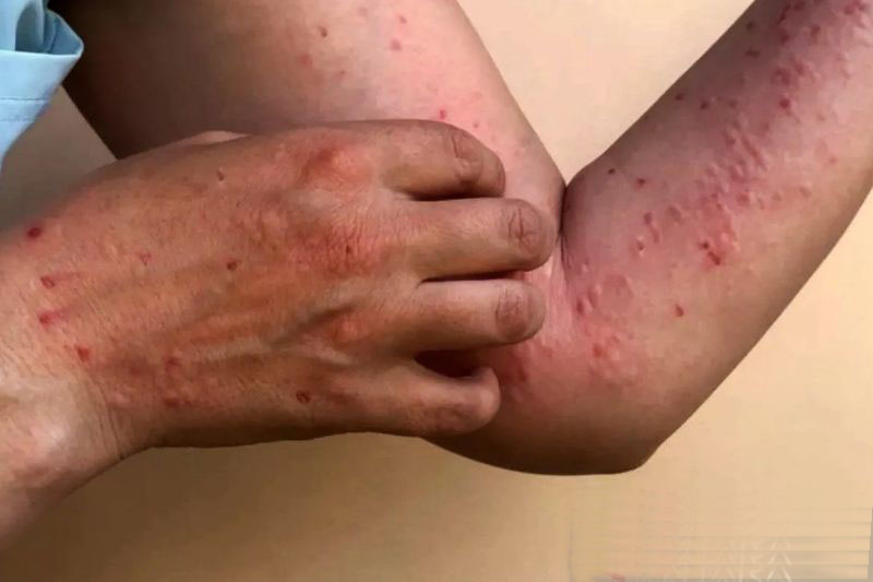 China perketat kontrol perbatasan untuk cegah masuknya mpox China perketat kontrol perbatasan untuk cegah masuknya mpox