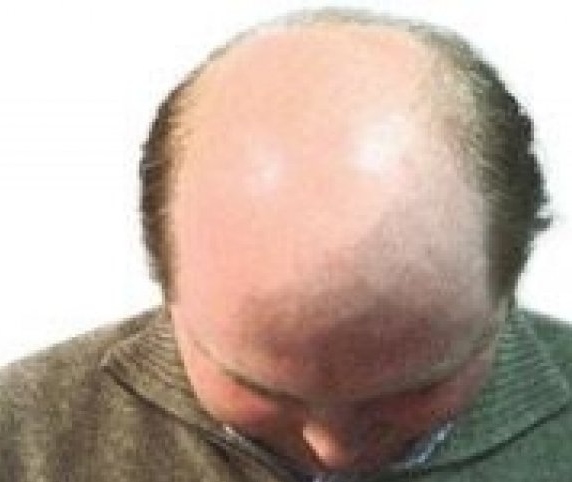 Waspadai kebotakan pada rambut dan cara meminimalkannya