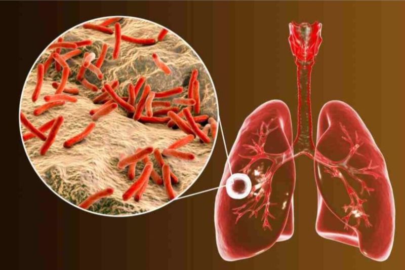 Ini kata dokter soal proses TB yang sebabkan penumpukan cairan di paru Ini kata dokter soal proses TB yang sebabkan penumpukan cairan di paru