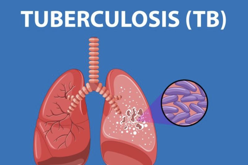 Menarik nafas tanpa takut tuberkulosis di 2030 Menarik nafas tanpa takut tuberkulosis di 2030