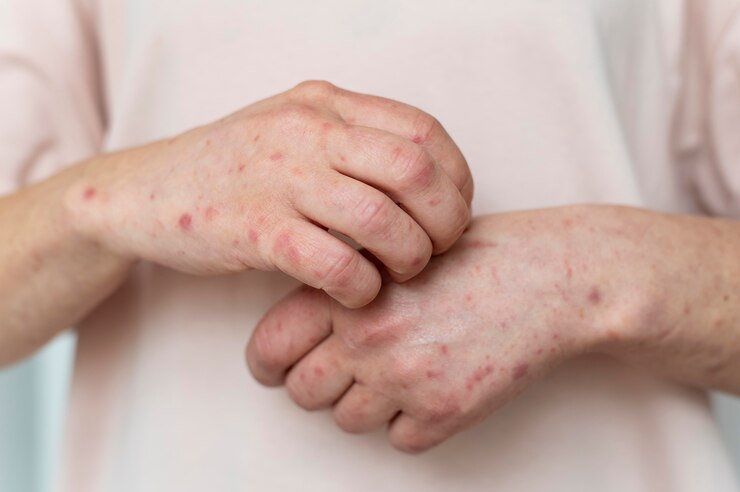Peringatan Hari Lupus Sedunia, kenali dan terapkan budaya hidup sehat Peringatan Hari Lupus Sedunia, kenali dan terapkan budaya hidup sehat