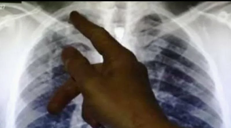 Dokter: Perokok aktif di atas 40 tahun perlu skrinin kanker paru