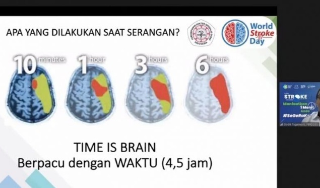 Dokter ingatkan stroke harus ditangani tidak lebih dari 4,5 jam Dokter ingatkan stroke harus ditangani tidak lebih dari 4,5 jam