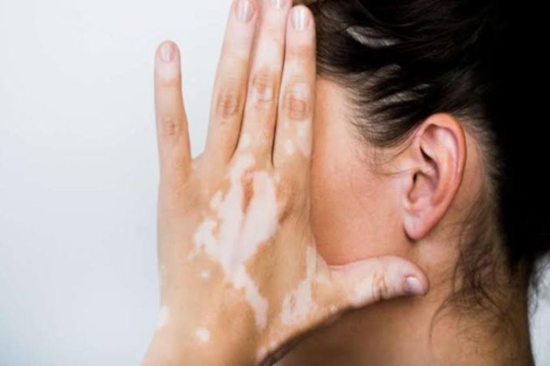 C Derma beri edukasi terkait vitiligo untuk dobrak stigma masyarakat C Derma beri edukasi terkait vitiligo untuk dobrak stigma masyarakat