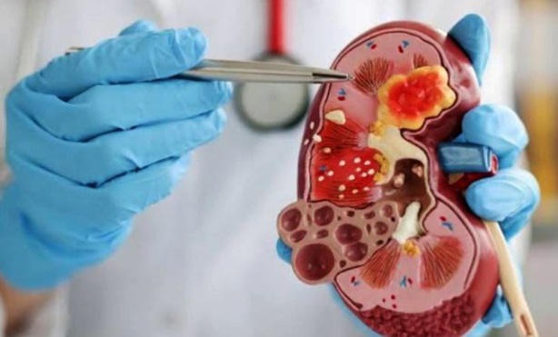 Dokter sebutkan delapan langkah emas guna cegah penyakit ginjal Dokter sebutkan delapan langkah emas guna cegah penyakit ginjal