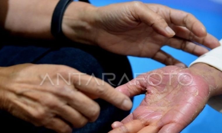 Dokter ungkap autoimun bukanlah penyakit menular Dokter ungkap autoimun bukanlah penyakit menular