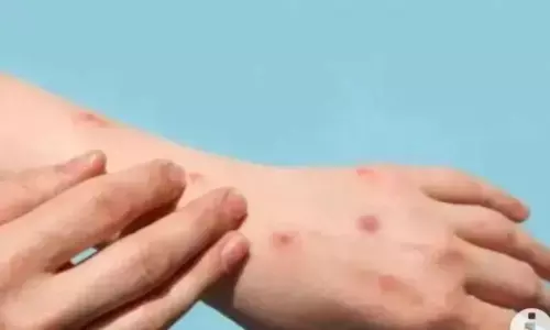Kemenkes: Tahun ini tak ada kasus Mpox di Indonesia Kemenkes: Tahun ini tak ada kasus Mpox di Indonesia