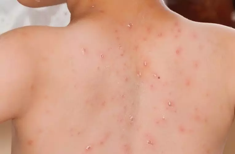 Dinkes Tangerang Selatan catat penyakit campak capai 538 kasus Dinkes Tangerang Selatan catat penyakit campak capai 538 kasus