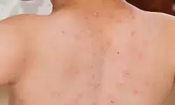 Dinkes Tangerang Selatan catat penyakit campak capai 538 kasus Dinkes Tangerang Selatan catat penyakit campak capai 538 kasus