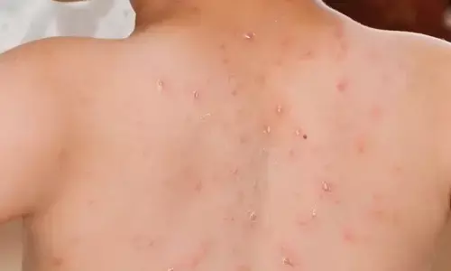 Dinkes Tangerang Selatan catat penyakit campak capai 538 kasus