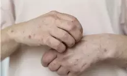 Kemenkes respons notifikasi campak WNA yang perjalanan dari RI