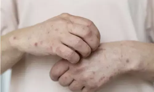 Kemenkes respons notifikasi campak WNA yang perjalanan dari RI