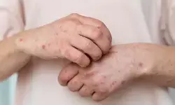 Tiga fase gejala yang perlu diwaspadai terkena campak