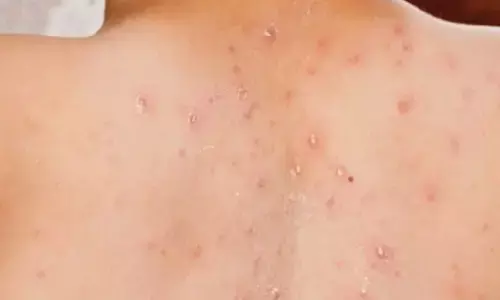 Dinkes: Ratusan kasus campak ditemukan di Subang