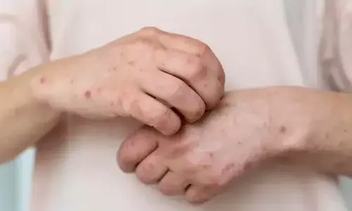 Empat daerah di Sumsel ditetapkan KLB campak